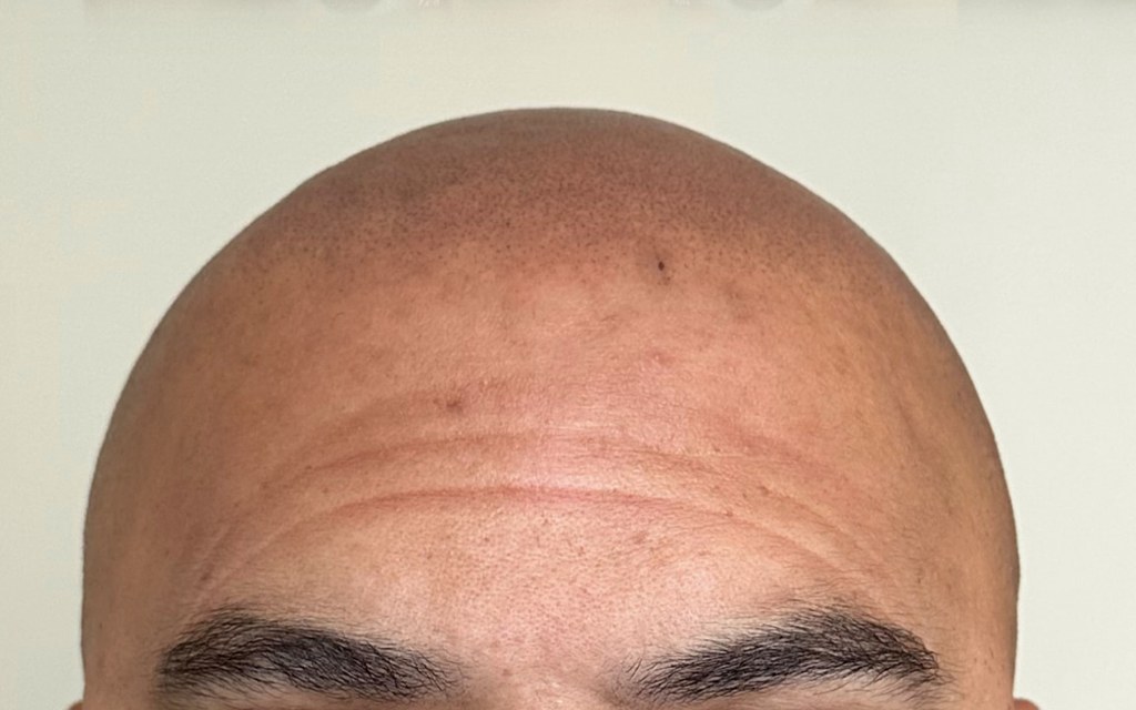 Tricopigmentation — après